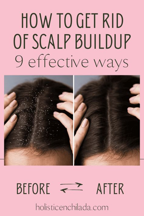 Wondering how to get rid of scalp buildup? Explore these 9 highly effective ways to achieve a cleaner, flake-free scalp with these expert-recommended strategies. How To Get Rid Of Flakes In Hair, How To Get Rid Of Product Build Up, Remove Buildup From Scalp, What Helps With Dry Scalp, Flakey Scalp How To Get Rid Of, Dry Itchy Flaky Scalp Remedy, Oily Scalp Remedy Diy, How To Deal With Dandruff, Remove Scalp Buildup Diy