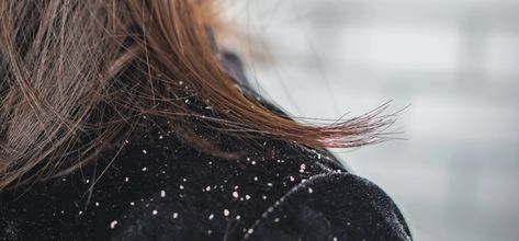 No one likes a flake, especially the ones that fall from your scalp. Here are the best natural remedies for dandruff for major scalp relief. How To Remove Dandruff, Severe Dandruff, Natural Dandruff Remedy, Dandruff Causes, Home Remedies For Dandruff, Dandruff Remedy, Getting Rid Of Dandruff, Ayurvedic Remedies, Avocado Smoothie