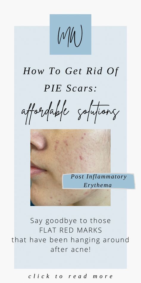 Post Inflammatory Erythema, Red Spots On Face, Dark Marks On Face, Red Acne Marks, Getting Rid Of Scars, Acne Scaring, Acne Redness, Post Inflammatory Hyperpigmentation, Skin Facts