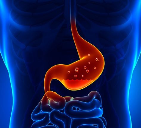 Stomach acid is a necessary and vital part of digestion. Yet, stomach acid has become enemy number one in the United States. Fast Tract Diet, Ibs Diet Plan, Ibs Diet, Stop Acid Reflux, Low Stomach Acid, Reflux Disease, Stomach Ulcers, Irritable Bowel, Stomach Acid