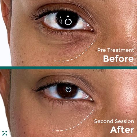 Put down the eye cream, babe! Restores lost volume & creates a more balanced facial symmetry with PRF 💉Stimulates new collagen ✨ Enhances regrowth of new healthy skin 🧚🏻⁠
#
Under eye filler before and after
Dark circles under the eyes remedies
Under eye fillers
Under eye wrinkles
Bags under eyes remedy
Face fillers
Fillers before and after
Eye bags remedy
Vaseline under eyes
How to get rid of eye bags
Eye bags aesthetic
Dark circles
How to get rid of dark circles under eye Eye Wrinkles Before And After, Filler Under Eyes Before And After, Eye Bags Aesthetic, Vaseline Under Eyes, Eye Bags Remedy, Dark Circles Under The Eyes Remedies, Bags Under Eyes Remedy, Under Eye Filler, Undereye Bags Remedy