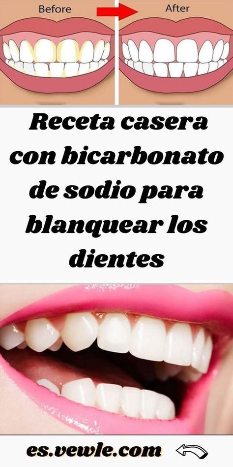 Dientes blancos 😍 : 7 remedios naturales para tener la sonrisa perfecta 🦷 Esthetic Dentistry, Dental Life, Smile Makeover, Smile Design, Perfect Smile, Oral Health Care, Cosmetic Dentistry, White Teeth, Tooth Decay