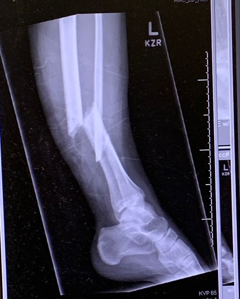 Broken Hands Fake Story, Broken Leg In Hospital, Leg Fracture Snap, Broken Leg Snapchat Story, Leg Fracture Snapchat, Leg Accident Real Pic, Injured Leg Snapchat, Broke Leg Snapchat, Fracture Photo