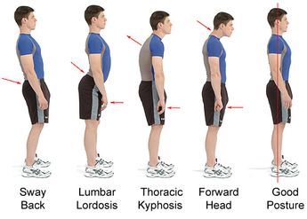 9 Easy remedies for cervico occipital neuralgia - Migraine Professional Psoas Iliaque, Lumbar Lordosis, Posture Fix, Rotator Cuff Injury, Posture Exercises, Mobility Exercises, Rotator Cuff, Bad Posture, Body Posture