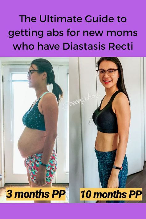 This is a before and after picture when I was 3 months and 10months postpartum with my second child. In this post, I talked how to heal and get abs again with exercises. I talked about the symptoms having diastasis recti and how to correctly fix it with. Pin it  and then click to read it!  #diastasisrecti #abdominalseparation 3 Months Post Partum Belly, Diastis Recti Before And After, Diastis Recti Exercises Before And After, Mom Belly Before And After, 3 Months Postpartum, Diastasis Recti Before After, Diastis Recti, Diastasis Recti Repair, What Is Diastasis Recti