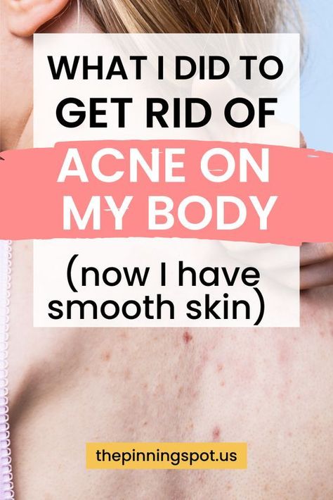 What I did to get rid of body acne for good (I have smooth body skin) Clear Body Acne, Clear Back Acne, Smooth Body Skin, Get Rid Of Body Acne, Shoulder Acne, Smooth Skin Body, Cystic Acne Remedies, Acne Tips, Chest Acne