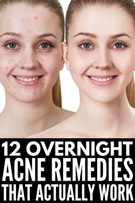 What Causes Warts, Sunspots On Face, Overnight Acne Remedies, Brown Age Spots, Brown Spots On Skin, Acne Overnight, Pimples Overnight, Skin Care Routine For 20s, Get Rid Of Warts