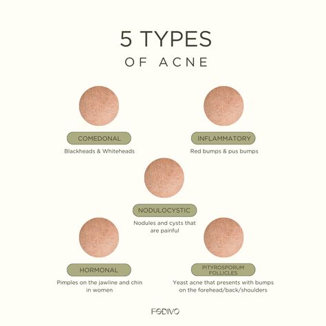 Acne Hacks, Facial Routine Skincare, Skin Facts, Skin Care Basics, Facial Routines, Skin Aesthetics, Types Of Acne, Body Acne, Acne Causes