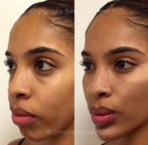 This 5-Minute Procedure Gives You the Same Feature That Successful People Have- Cosmopolitan.com Face Injections, Cheek Implants, Chin Filler, Chin Augmentation, Cheek Lift, Chin Implant, Face Fillers, Botox Before And After, Botox Face