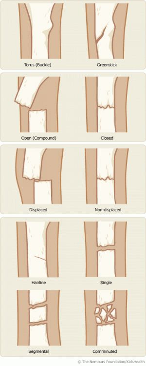 Fracture Types Types Of Fractures, Muzică Rock, Studera Motivation, Bone Fracture, Nursing School Studying, Nursing School Tips, Medical School Studying, Nursing School Notes, Medical Terminology