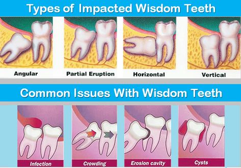 Do you know? 10 million impacted wisdom teeth are removed every year also 2%of people will get no wisdom teeth. After wisdom teeth removal Mission Hills, the recovery phase depending on your health may take two weeks or more. However, looking after the surgical area with proper care can help you heal better and quick. Soft Foods After Surgery Teeth, Wisdom Teeth Meme, Dentistry Notes, Dental Assistant Study Guide, Dental Nursing, Wisdom Teeth Recovery, Tooth Pain Remedies, Impacted Wisdom Teeth, After Wisdom Teeth Removal