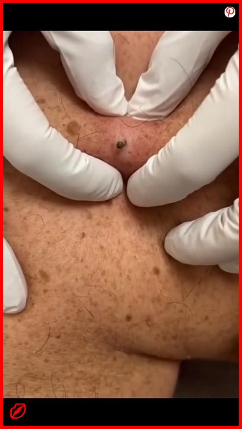 📌 Perfect Skin – The Comprehensive Solution for All Your Needs! zits popping, squeezing pimples, blackheads popping videos faces #PimplePatch #beautyroutine #zits #glowingskin Squeezing Blackheads, Remove Blackheads From Nose, Best Dark Spot Corrector, Blackhead Remover Diy, Zit Popping Videos, Zits Popping, Clean Blackheads, Pimples On Face, Face Acne