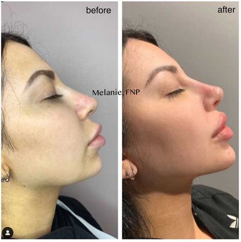 How to Use Chin Fillers to give Angulairity and a better Jawline to a Round Face - My Beauty Consultant Perfect Chin Shape, V Chin Aesthetic, Lip Filler Round Lips, Round Lip Filler, Chin Fillers Before After Round Face, Round Lips Filler, Cheekbone Filler Before And After, Face Contouring Fillers, Better Jawline