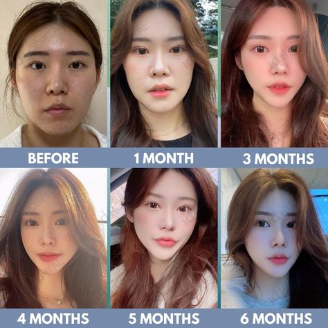 #idhospitalkorea #koreanplasticsurgery #plasticsurgery #plasticsurgerykorea #cosmeticsurgery #seoul #korea #IDtransformation #IDbeforeandafter #plasticsurgerybeforeandafter #beforeandafter #beforeandaftersurgery #besttransformation #vline #vlinesurgery #vshapeface #facialcontouring #cheekbonereduction #ptosiscorrection #eyelidssurgery Cheekbone Reduction, V Line Surgery, Plastic Surgery Korea, Korean Plastic Surgery, Cotton Suit Designs, V Shape Face, Reduction Surgery, Facial Contouring, Dump Ideas