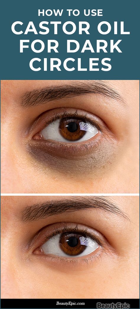 Reduce Eye Bags, Dark Circle Remedies, Dark Circles Around Eyes, Dark Circles Treatment, Dark Eye Circles, Eye Cream For Dark Circles, Skin Care Wrinkles, Reduce Dark Circles, Dark Circles Under Eyes