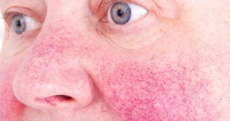 Twelve top tips for dealing with rosacea Skin Bumps, Elderly Woman, Skin Condition, Skin Disorders, Skin Diseases, Dermatology, Skin Problems, Skin Conditions, Facial Skin