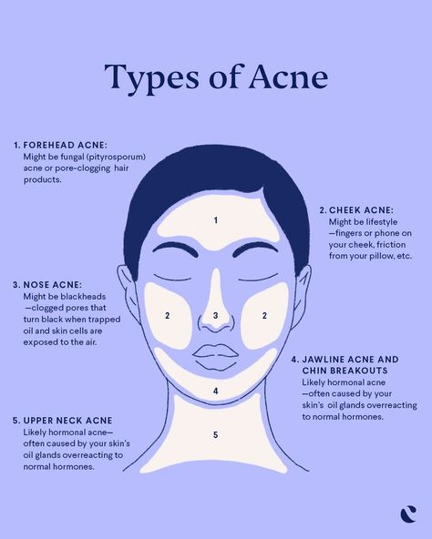 Figuring out what causes acne can be tough, but helping to prevent breakouts just takes a little detective work. Acne face mapping can be key to helping identify the acne cause. While many factors can lead to acne breakouts, the location on your face can be a revealing clue. Click now to find out the meaning behind pimples on your chin, cheeks, jawline and neck. Pimple Face Mapping, Cheek Pimples, Pimple Face, Jawline Acne, Cheek Acne, Neck Acne, Face Map, Chin Acne, Face Acne Treatment