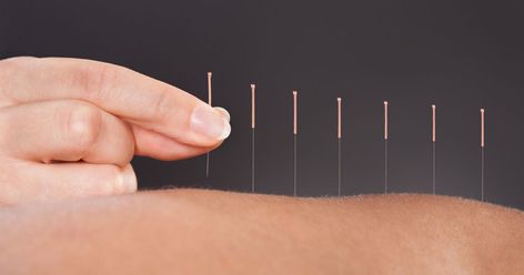 Researchers pinpoint how acupuncture targets inflammation – Harvard Gazette Arnica Gel, Acupuncture Benefits, Hip Exercises, Low Libido, Acupuncture Points, Traditional Chinese Medicine, Acupressure, Chinese Medicine, Natural Treatments