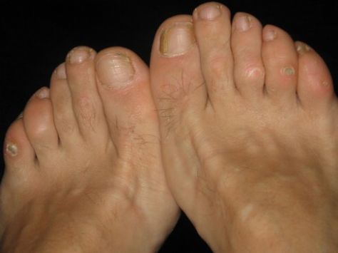 9. Calluses and Corns Get Rid Of Corns, Corn Removal, Castor Oil Uses, Vinegar Benefits, Vinegar Uses, Foot Soak, Callus Removal, Oil Benefits, Oil Uses