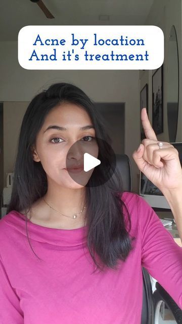 Dr.Nidhi Sawant on Instagram: "Acne can appear in various locations on the body, not just the face. The location of acne can provide insights into potential causes or contributing factors. . Forehead: Causes: Haircare products. Oily scalp. Digestive issues. Types: Whiteheads, blackheads. Use soap which contains ketoconazole and anti-dandruff shampoo. Cheeks: Causes: Dirty pillowcases or phones. Poorly cleaned makeup brushes. Hormonal fluctuations. Types: Whiteheads, blackheads, papules, pustules. Use a clindamycin+ nicotinamide gel or Salicylic acid facewash. Chin and Jawline: Causes: Hormonal fluctuations (common in women). Polycystic Ovary Syndrome (PCOS) in some cases. Types: Hormonal acne, cystic acne. Use benzoyl peroxide cream or Adapalene gel. Back (Back Acne or Bacne): Ca Pimple Area Meaning, Acne Location Meaning, Clindamycin For Acne, Chin Whiteheads, Cheek Acne Cause, Forehead Acne Cause, Cheek Pimples, Acne On Cheeks, Chin Acne Causes