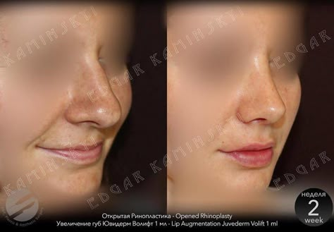 Eye Lift Surgery, Nose Surgery Rhinoplasty, Nose Job Inspo, Dream Nose, Bulbous Nose, Plastic Surgery Fail, Rhinoplasty Nose Jobs, Face Surgery, Rhinoplasty Before And After