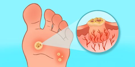 Plantar warts are painful growths on the bottom of your feet that can stick around for years if left untreated. Plantar Wart Removal, Planters Wart, Plantar Warts, Home Remedies For Warts, Warts Remedy, Get Rid Of Warts, Laser Therapy, Reproductive Health, Laser Treatment