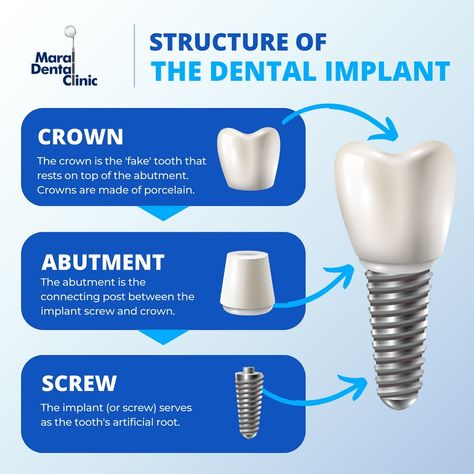 Dentist and Dental Clinic in Scarborough Fake Teeth, Teeth Implants, Dental Implant, Dental Implants, Dental Clinic, Media Design, Social Media Design, Screw, Toronto