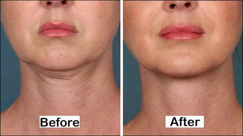 5 Simple Ways To Tighten Your Neck Skin Obličejové Masky, Reduce Face Fat, Reduce Double Chin, Double Menton, Natural Face Lift, Facial Fillers, Face Exercises, Yoga Facial, Facial Exercises