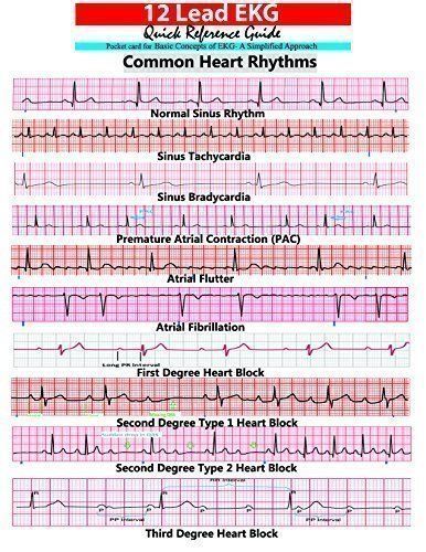 Cardiology Nursing, Ekg Interpretation, Paramedic School, Nursing Cheat, Nursing Mnemonics, Cardiac Nursing, Nursing School Survival, Critical Care Nursing, Heart Rhythms