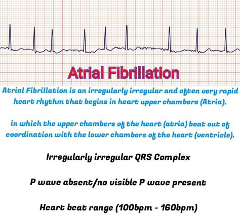 Findings

Atrial Fibrillation (Afib)

Afib stands for atrial Fibrillation (AF)

Atrial Fibrillation is a type of arrhythmia or abnormal heart beat and is a major cause of stroke. 


Irregularly irregular QRS Complex

P wave absent/no visible P wave present

For complete article, Visit website Afib Atrial Fibrillation, Human Circulatory System, Ecg Interpretation, P Wave, Medical Tech, Heart Palpitations, Atrial Fibrillation, Heart Rhythms, Irregular Patterns