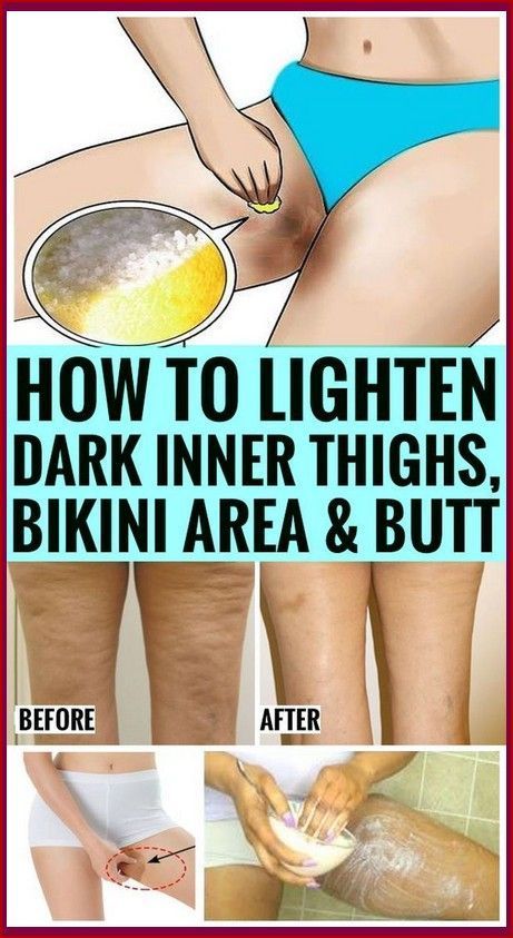 How To Get Rid Of Dark Inner Thighs Naturally Dark Inner Thighs, Sarah Robinson, Tiny Shorts, Beyonce Outfits, Micro Mini Skirt, Yoga Pant, Inner Thigh, Healthy Skin Care, Micro Mini