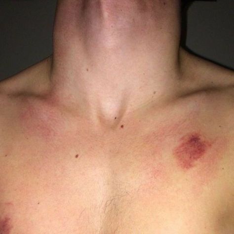 Hand Around Neck Aesthetic, Hickey On Boy, Love Bite Photos Aesthetic, Aesthetics Hickeys, Love Bite Photos Couples, Love Bites Hickey For Boys, Hickies Neck Boys, Aesthetic Couple Hickey, Neck Bite Boyfriend