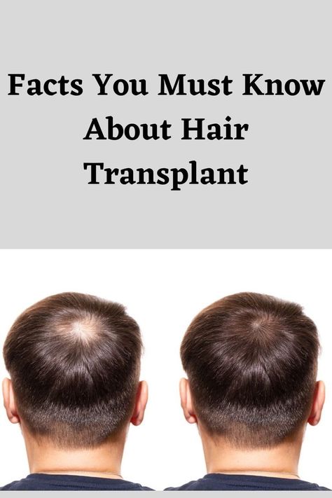 A hair transplant is a surgical process. There are several techniques that doctors can use to do a hair transplants and it’s best to choose the hair transplant methods carefully, as they all have their own pros and cons. This Links examines the facts about hair transplant surgery. Hair Transplant Before And After, Facts About Hair, Products For Thinning Hair, Hair Replacement For Men, Hair Implants, Receding Hair Styles, Hair Facts, Fue Hair Transplant, Hair Transplant Surgery