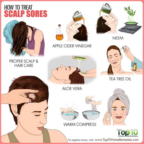 How to treat scalp sores Sores On Scalp Remedies, Sore Scalp Remedies, Healthy Scalp Treatments, Scalp Excema, Scabs On Scalp, Hair Problems Remedies, Scalp Sores, Itchy Scalp Remedy, Dry Scalp Remedy