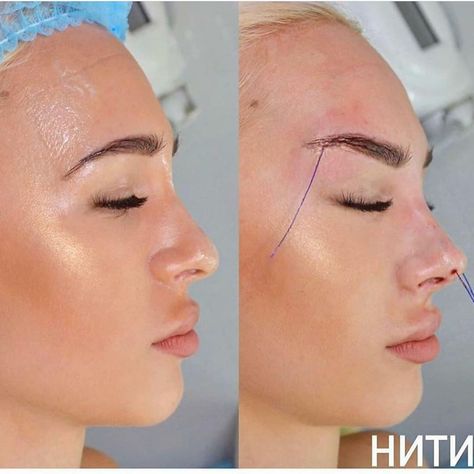 Cosmetic Insider’s Instagram photo: “"Fox Eyes" 🦊😮 PDO threading and botox 💉 to lift the eyebrows 😱⠀ .⠀ .⠀ What do you think of this effect - do you like this look? 🤔 Leave a…” Left Eye Aesthetic, Eyebrow Lift Surgery, Eye Lift Surgery, Thread Lift Face, Brow Lift Surgery, Face Plastic Surgery, Nose Surgery Rhinoplasty, Botox Brow Lift, Eye Aesthetic