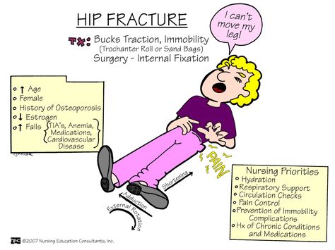 Hip Fracture | Nursing Mnemonics and Tips Geriatric Nursing, Nursing Information, Hip Fracture, Nursing Board, Nursing Assessment, Nursing Mnemonics, Surgical Nursing, Medical Surgical Nursing, Nursing School Survival