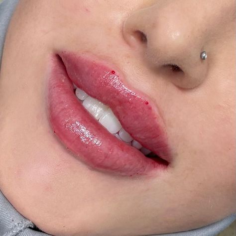 Dr. Ben Shatil on Instagram: “Dr. Ben’s Signature RUSSIAN LIPS 💉 Swipe ⬅️ for Before and after 💣 . . 💉: Outpatient procedure ⏰: Takes 20 minutes 🤕: Pain is mild;…” Natural Russian Lips, Russian Keyhole Lips, Lips Before And After, Russian Lips Filler 1ml, Russian Doll Lips, Lip Filler Russian, Russian Lips Filler Before And After, 1 Ml Lip Filler Before And After, Upturned Lips