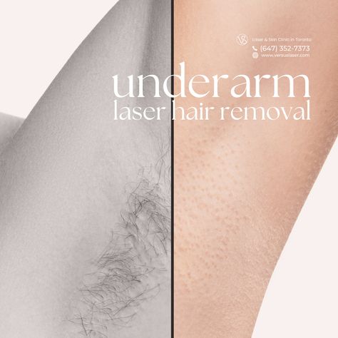 Laser Away Underarm Hair 🪒  Experience the ease of underarm care with our laser hair removal treatments! 🌟 Say farewell to razors and wax strips and hello to lasting smoothness.  🔹 Swift sessions 🔹 Long-term results 🔹 Comfortable experience 🔹 Reduced ingrown hairs  Lift your arms with confidence every day!   Book now:⁣ 💚 VS MedSpa Laser & Skin Clinic in Toronto:⁣  🌎https://www.versuslaser.com/ ⁣ Laser Hair Removal Sideburns, Laser Hair Removal Underarms, Laser Hair Removal Benefits, Laser Hair Removal Post Ideas, Laser Hair Removal Instagram Post, Laser Hair Removal Marketing Ideas, Laser Hair Removal Post, Laser Hair Removal Aesthetic, Laser Hair Removal Facts