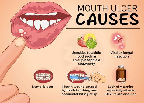 MOUTH SORES: EVERYTHING YOU NEED TO KNOW Ulcer Remedies Mouth, Dental Braces, Canker Sore, Cold Symptoms, Cold Sore, Health Guide, Chronic Condition, Autoimmune Disease, Mouthwash