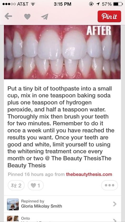 Get Whiter Teeth, Teeth Whitening Remedies, Teeth Whitening Diy, Skin Care Routine For 20s, Stronger Teeth, Best Teeth Whitening, Receding Gums, Natural Teeth Whitening, Whitening Kit