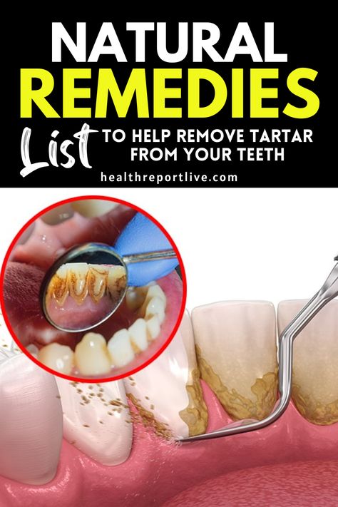 Natural Remedies List to Help Remove Tartar from your Teeth Get Rid Of Tartar On Teeth, How To Remove Plaque From Teeth, How To Get Rid Of Tartar Build Up, Tartar Build Up On Teeth, Brushing Teeth With Baking Soda, Get Rid Of Plaque On Teeth, Stained Teeth How To Get Rid Of, How To Get Rid Of Tartar On Teeth, Baking Soda And Peroxide Teeth