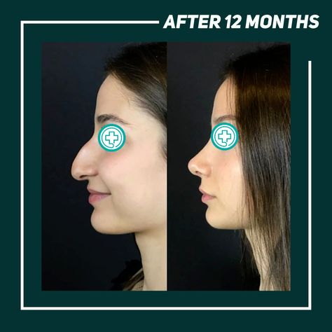 Dorsal Hump Rhinoplasty, Dorsal Hump Nose, Petite Nose, Makeup Scrapbook, Hump Nose, Aesthetic Needs, Visualization Board, Nose Jobs, Rhinoplasty Nose Jobs