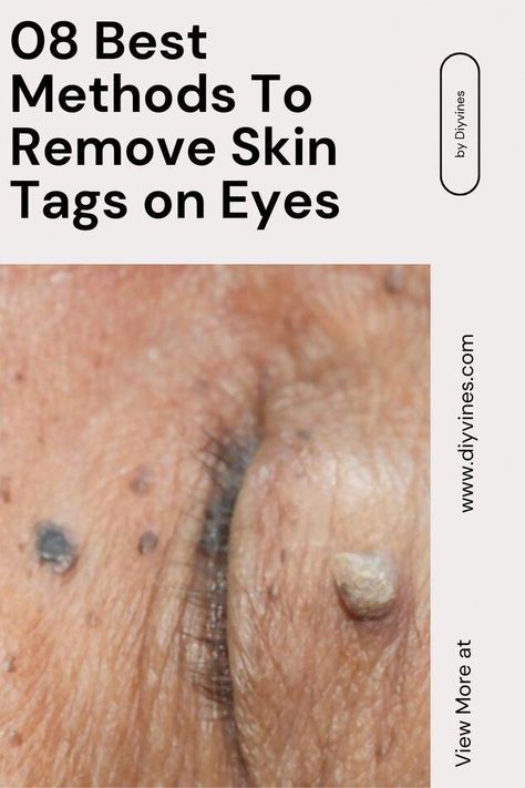 Remove Skin Tags, Remove Skin Tags Naturally, Skin Tags, Natural Health Care, Cold Sores Remedies, Natural Sleep Remedies, Natural Cold Remedies, Cold Home Remedies, Natural Cough Remedies