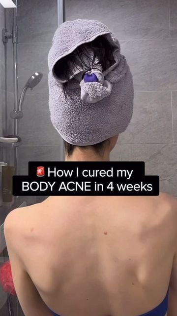 How To Treat Body Acne, Products For Back Acne, How To Remove Back Acne, Backne Skin Care, How To Treat Back Acne, Backne Remedies Fast, How To Clear Back Acne, How To Get Rid Of Body Acne, Body Acne How To Get Rid Of