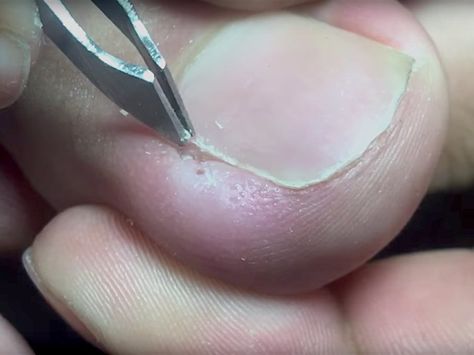 People are obsessed with videos of ingrown toenail removal  watch them if you dare Ingrown Toenail Removal Videos, Ingrown Toenail Removal, Toenail Removal, Toenail Health, Pretty Nails Glitter, Ingrown Toenail, Pretty Nail Colors, Red Manicure, Ingrown Toe Nail