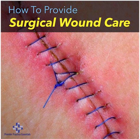 Providing Surgical Wound Care And Understanding the types of healing Open Wound Care, Wound Care Nurse, Wound Care Nursing, Pressure Ulcer, Rusty Nail, Types Of Skin, Wound Care, Post Partum, Scar Tissue