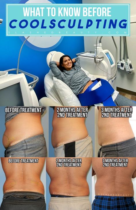 Love Handles Before And After, Body Sculpting Before And After, Cool Sculpting Before And After, Coolsculpting Before And After, Mommy Makeover Surgery, Body Surgery, Budget Beauty, Mommy Makeover, Cool Sculpting