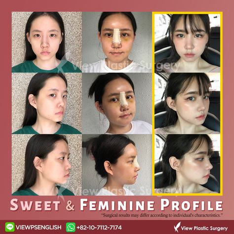 Our patient gained a doll-like nose with an accurate, slightly pointy tip and elegant, high nose bridge thanks to rhinoplasty! And Fat Graft made her face more refined as finishing touch for a feminine profile. Consult us for your Beauty 💕: - Whatsapp: +82 10 7112 7174 - KakaoTalk Plus Friend: viewpsenglish - Line: viewpsenglish - E-mail: eng_viewps@viewclinic.com - Website: viewplasticsurgery.com #rhinoplasty #nosesurgery #nosejob #nosefiller #nosefillers #perfectnose #rhinoplastyspecialist High Nose Bridge, Nose Fillers, Facial Bones, Perfect Nose, Nose Surgery, Nose Job, Nose Bridge, Plastic Surgery, Surgery