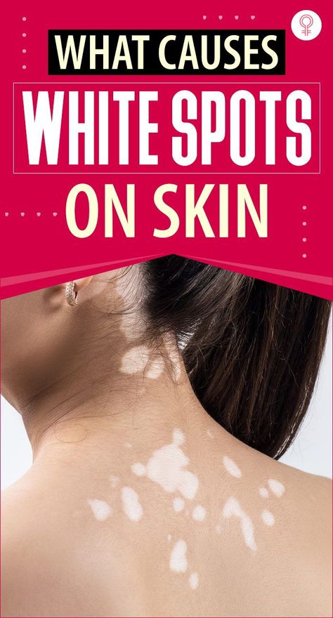 White Spots On Skin, White Skin Patches, White Skin Spots, Spots On Skin, Clogged Arteries, Tips Skincare, Brown Spots On Face, Skin Spots, Spots On Face