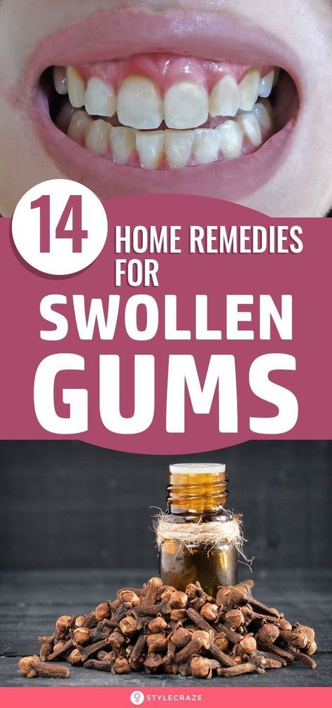 Swollen Gums Remedy, Swelling Remedies, Gum Inflammation, Remedies For Tooth Ache, Swollen Gum, Teeth Health, Gum Care, Receding Gums, Diy Remedies